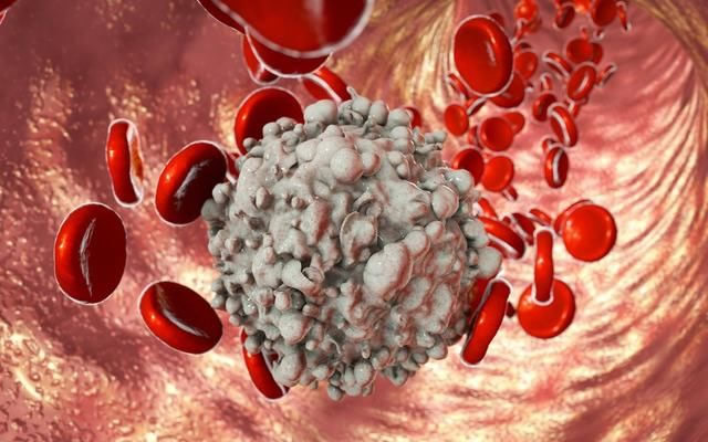 白血病自我診斷和護理措施